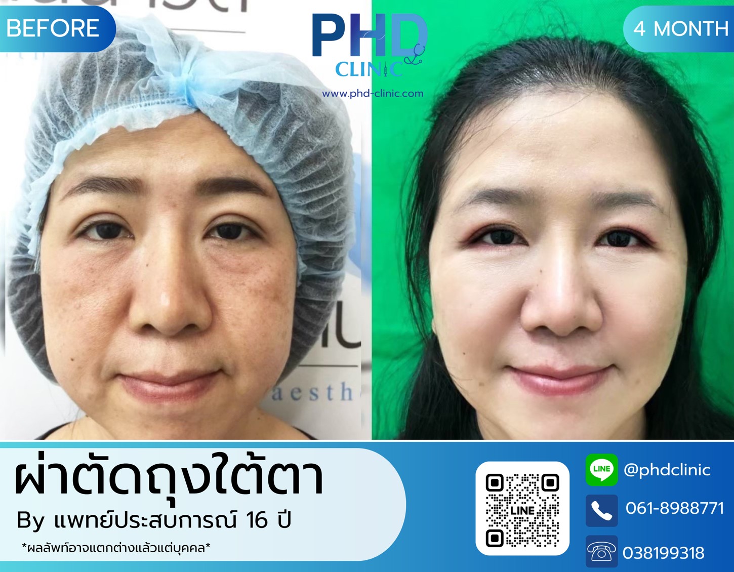 LINE_ALBUM_รีวิวถุงใต้ตา 3