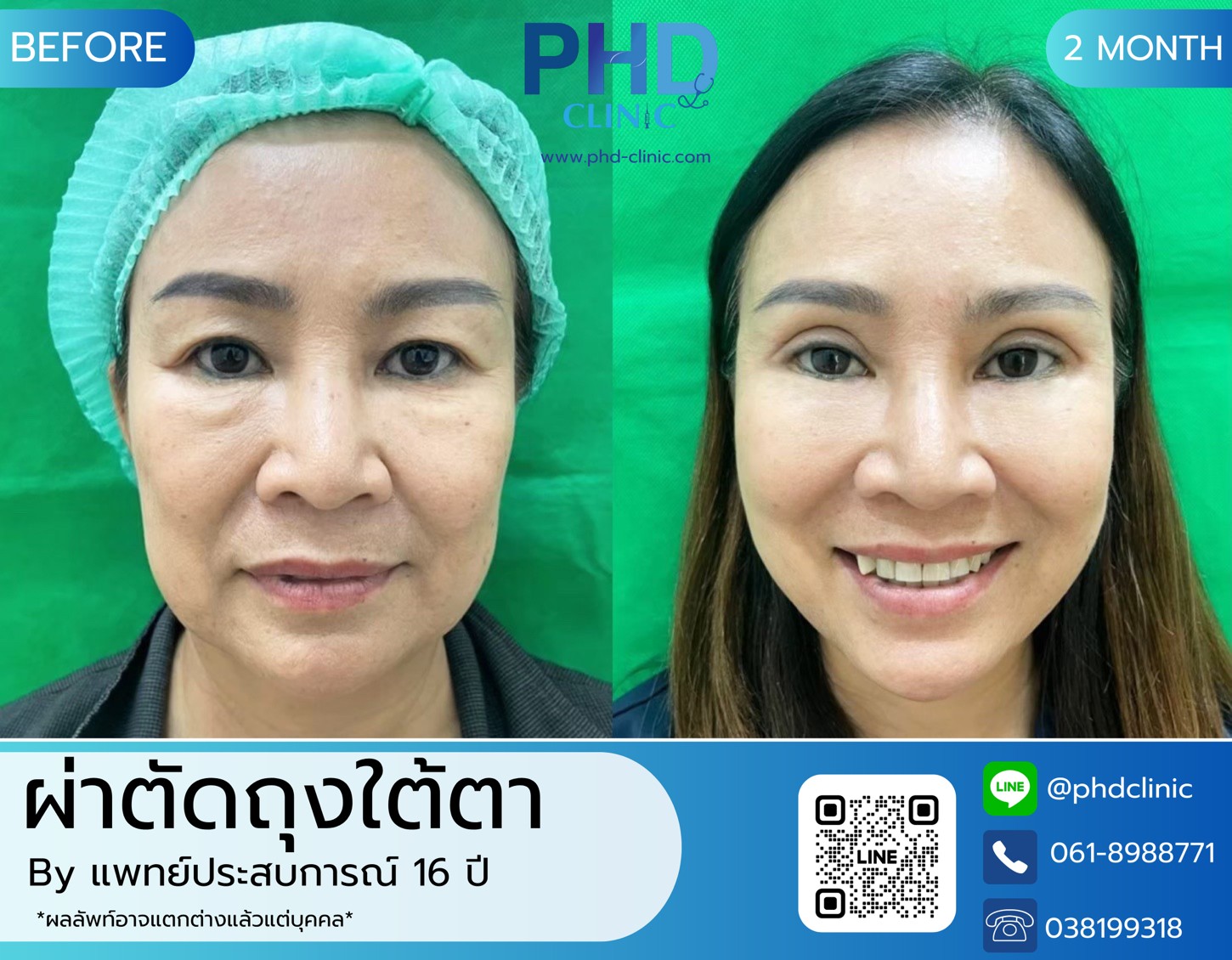LINE_ALBUM_รีวิวถุงใต้ตา 4