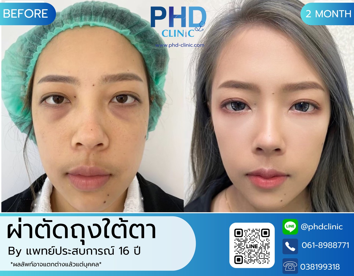 LINE_ALBUM_รีวิวถุงใต้ตา 5