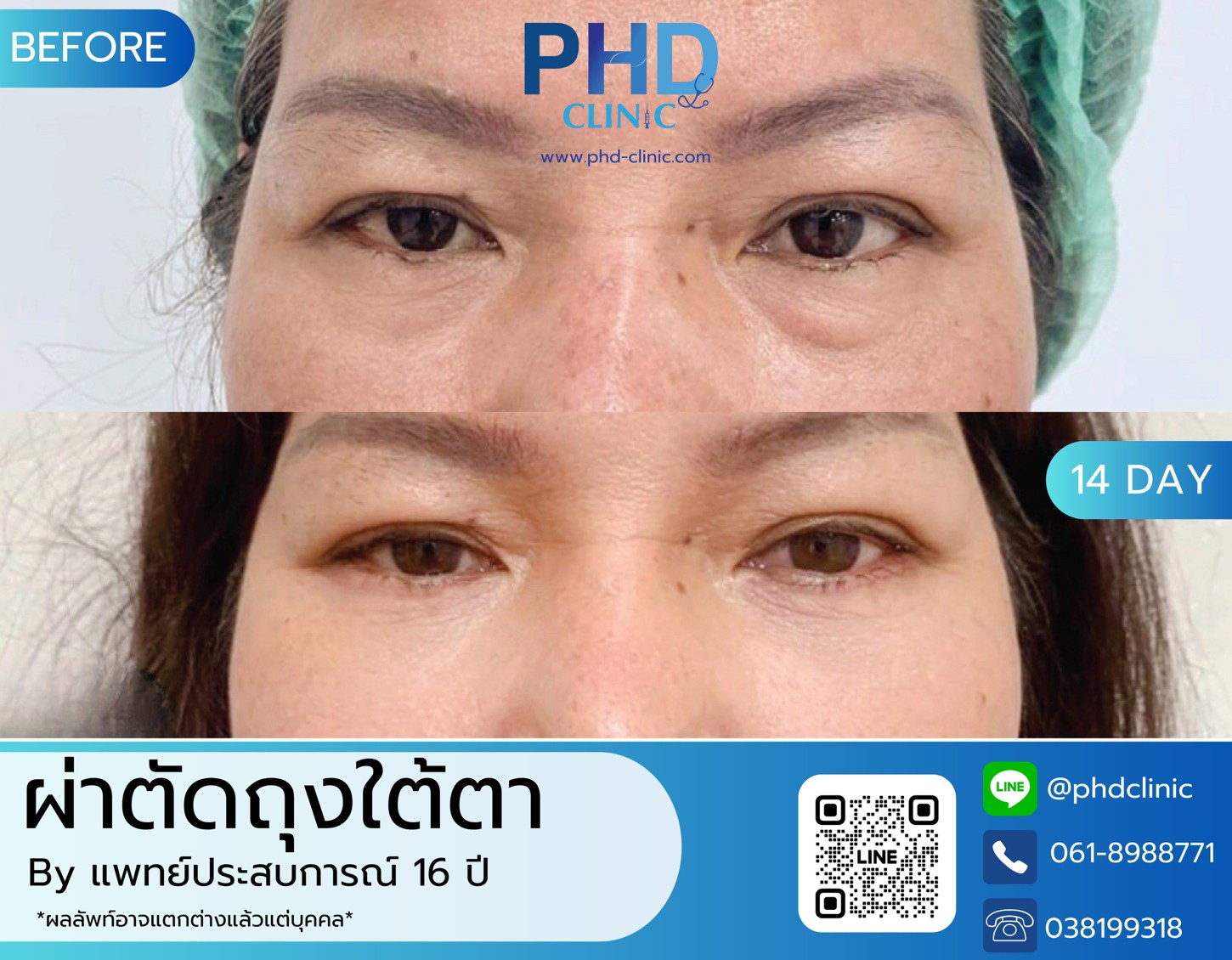 LINE_ALBUM_รีวิวถุงใต้ตา 7