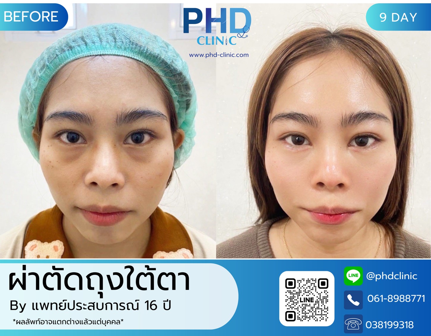 LINE_ALBUM_รีวิวถุงใต้ตา phd_๒๓๐๗๒๒