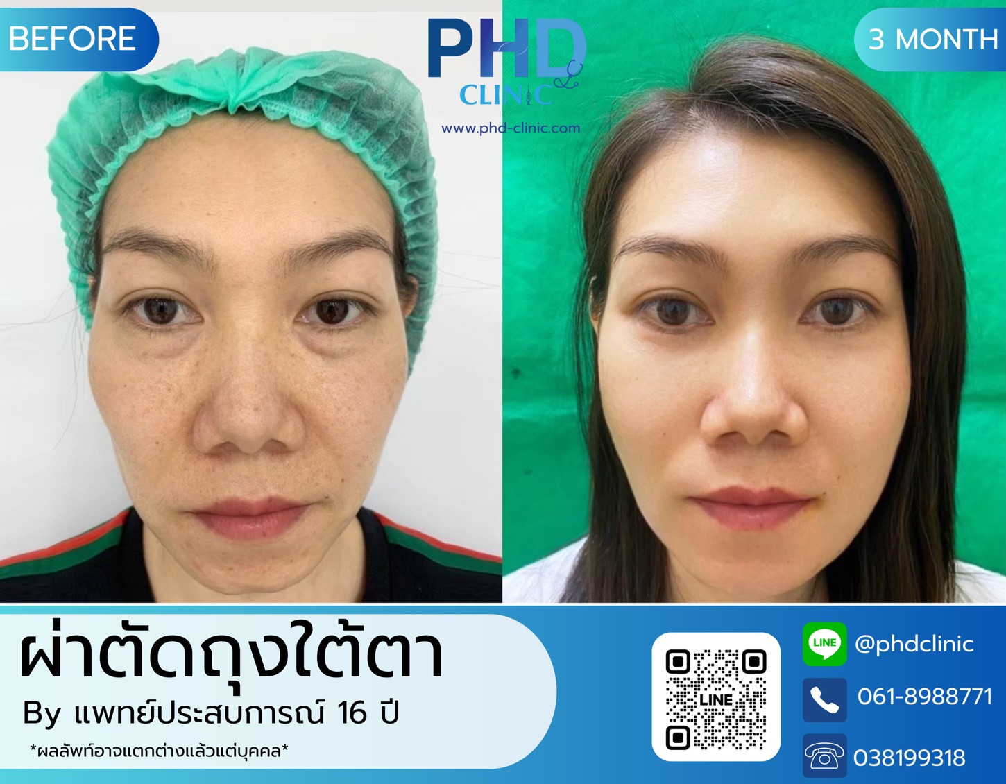 LINE_ALBUM_รีวิวถุงใต้ตา2