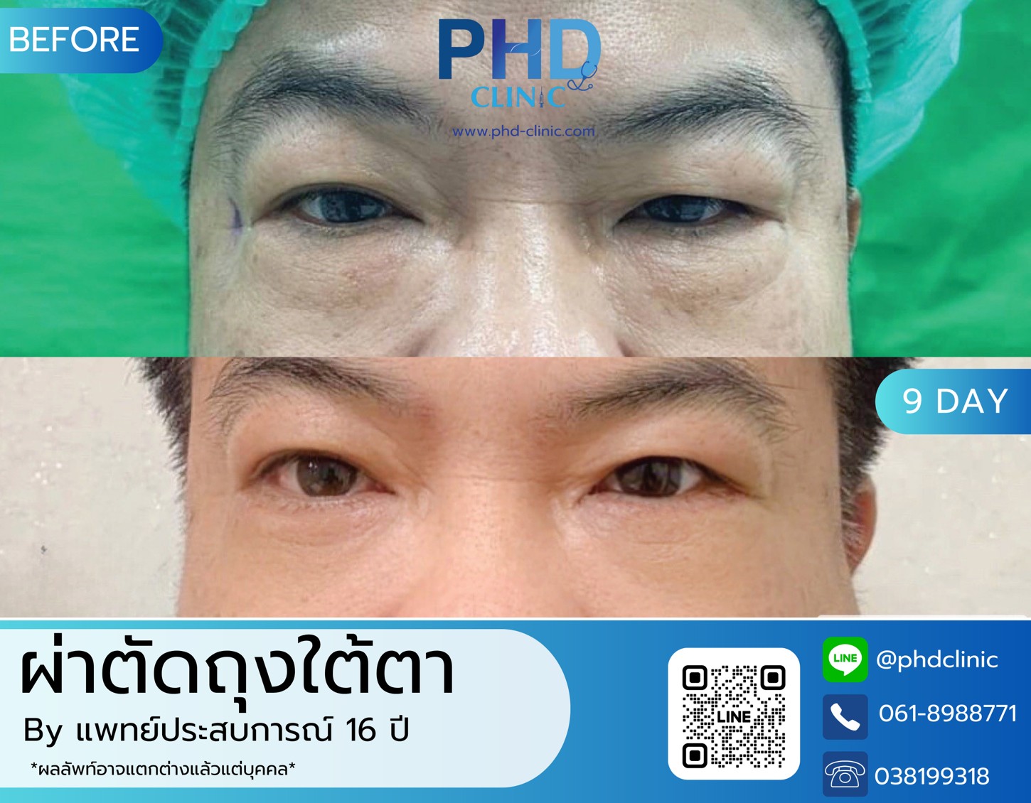 LINE_ALBUM_รีวิวถุงใต้ตา6