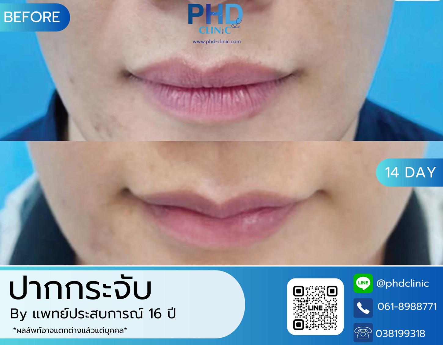 LINE_ALBUM_รีวิวปากกระจับ 1