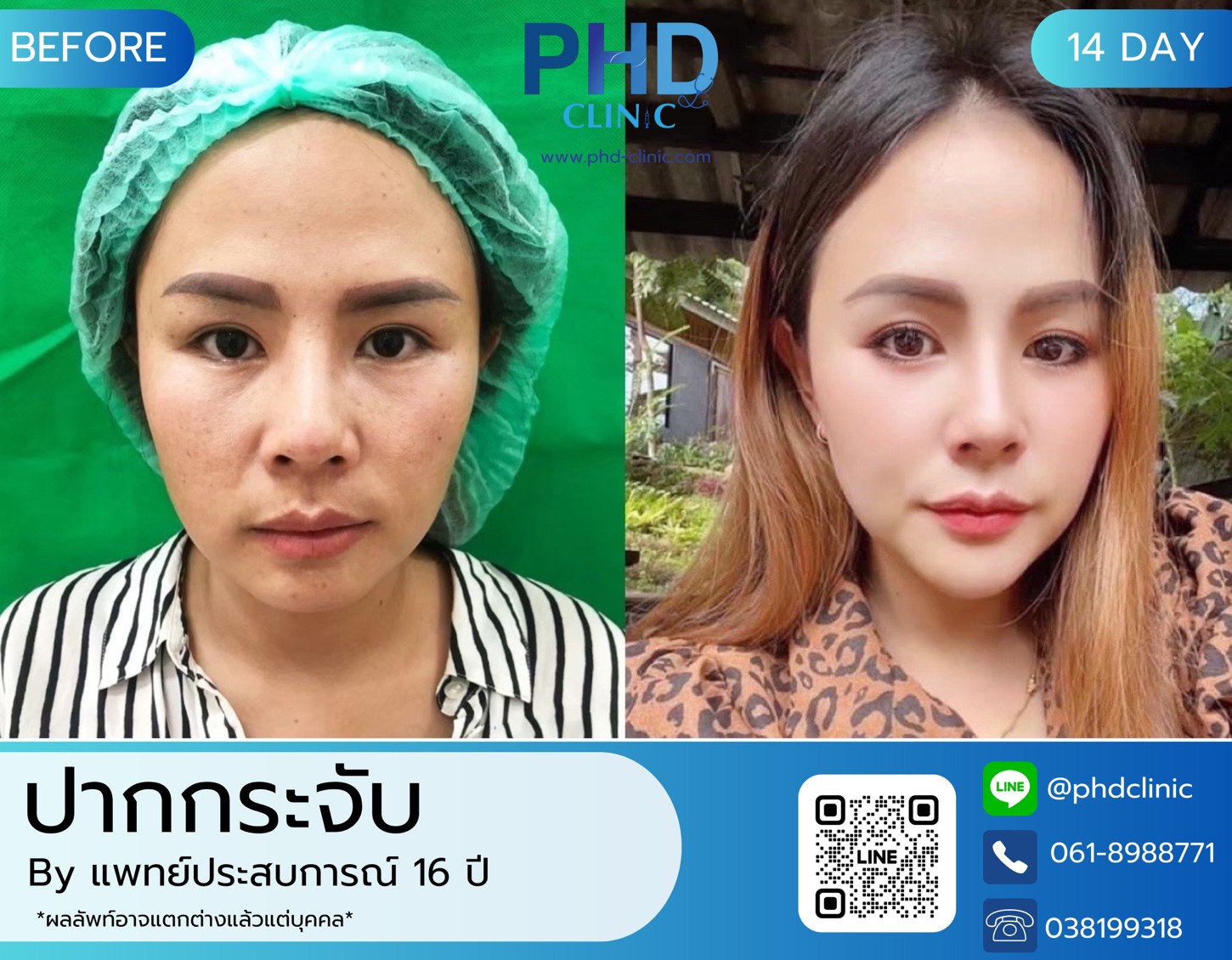 LINE_ALBUM_รีวิวปากกระจับ 10