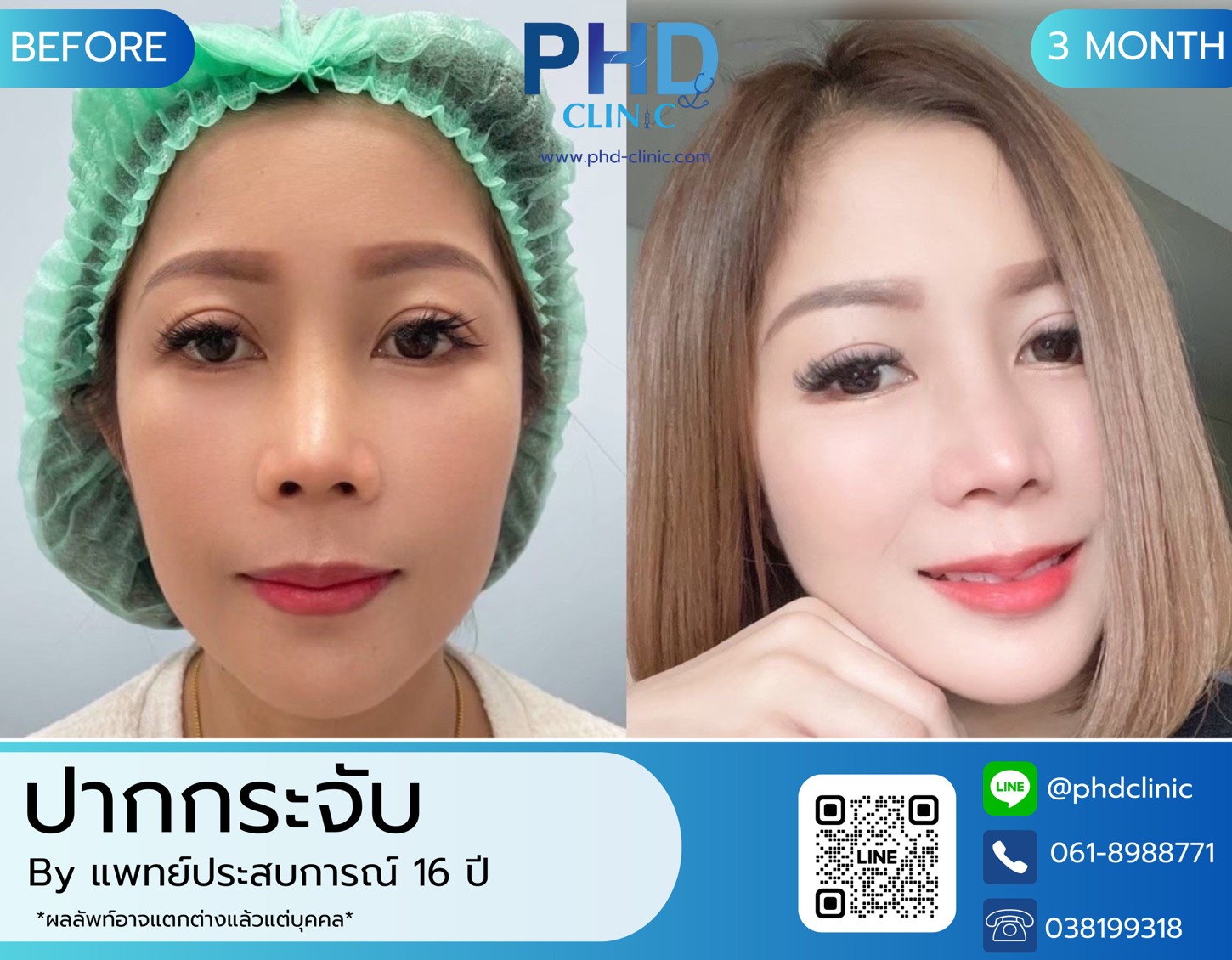 LINE_ALBUM_รีวิวปากกระจับ 4