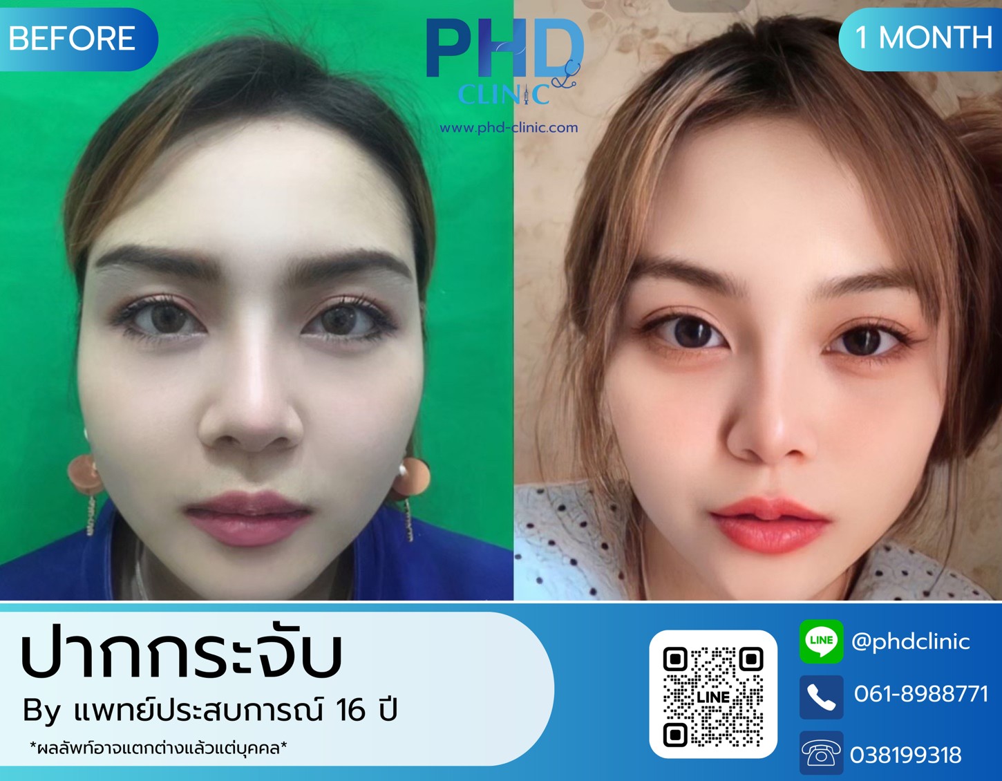 LINE_ALBUM_รีวิวปากกระจับ 5