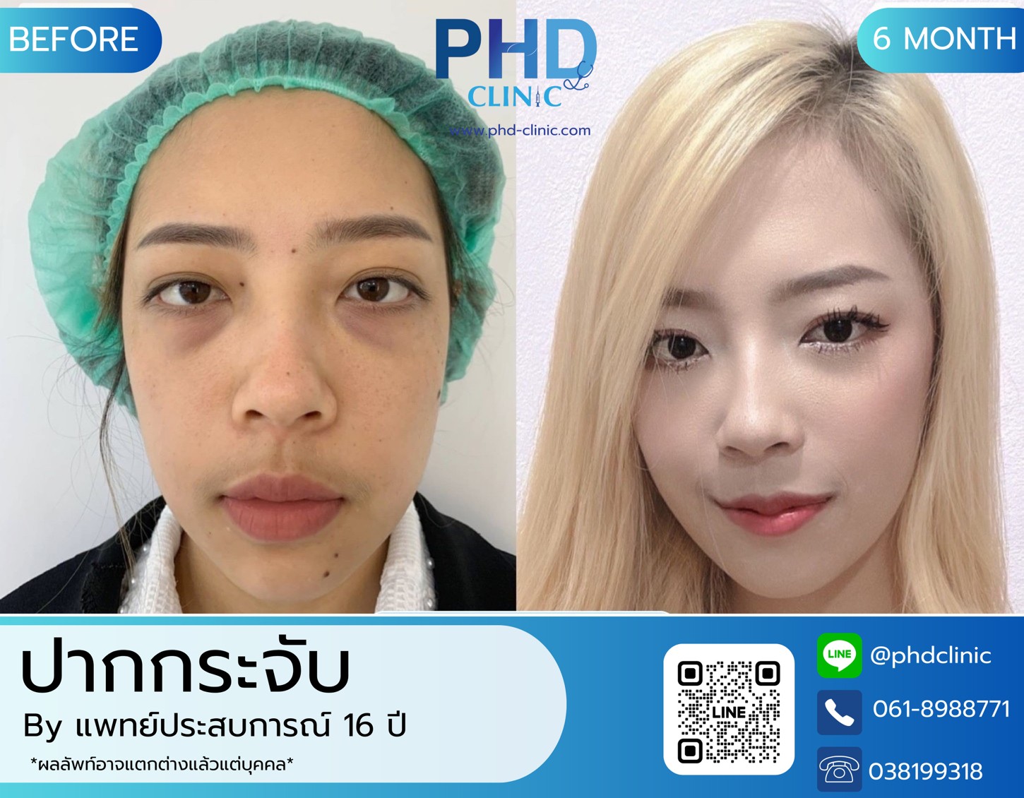 LINE_ALBUM_รีวิวปากกระจับ 6