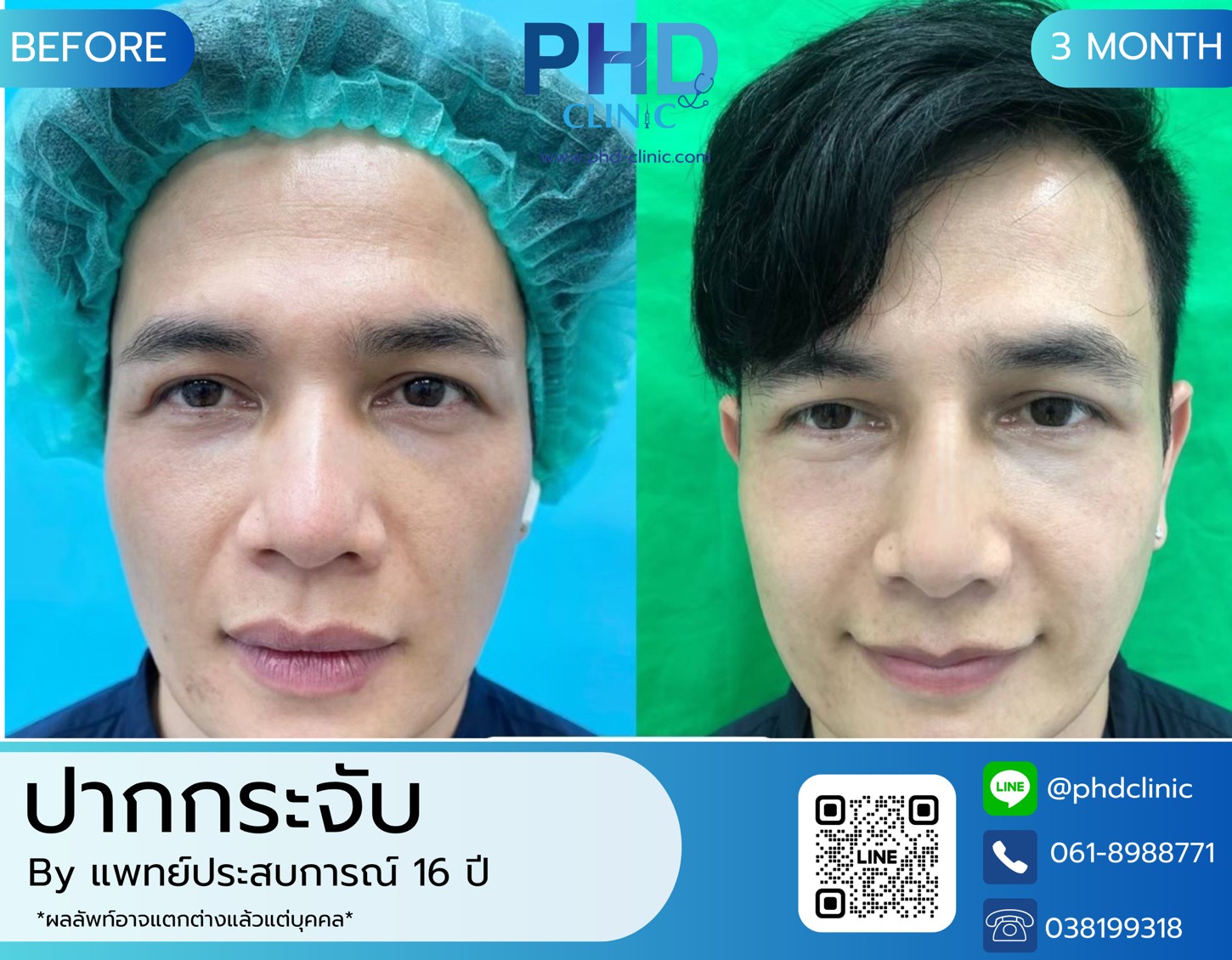 LINE_ALBUM_รีวิวปากกระจับ 7