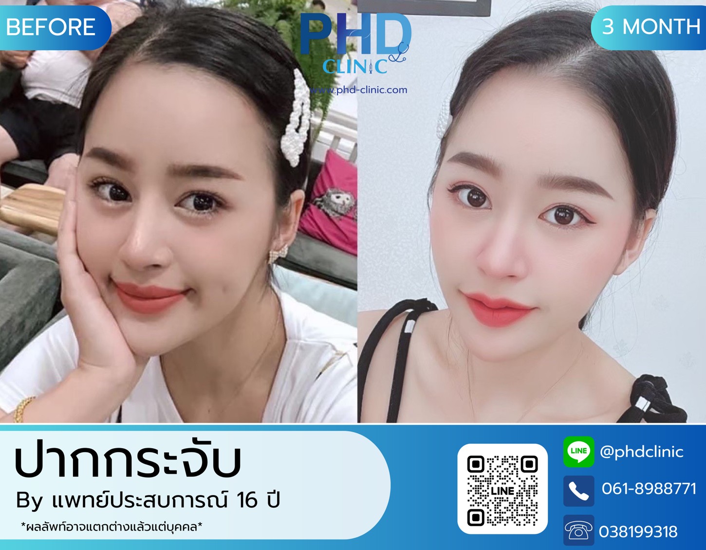 LINE_ALBUM_รีวิวปากกระจับ 8