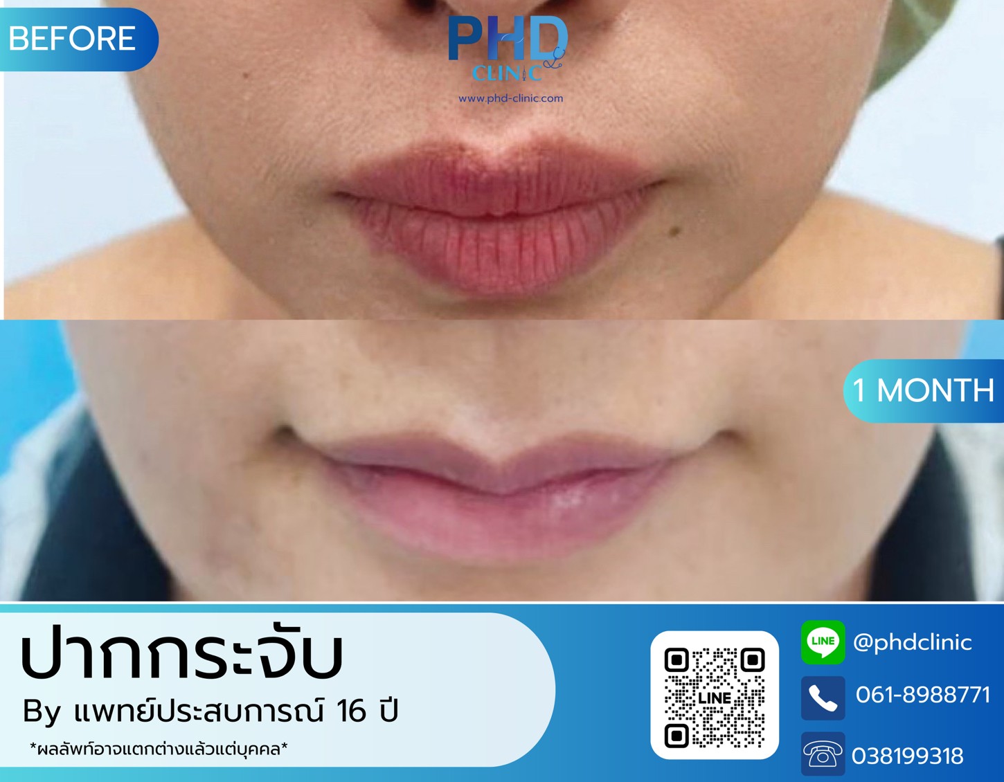 LINE_ALBUM_รีวิวปากกระจับ2
