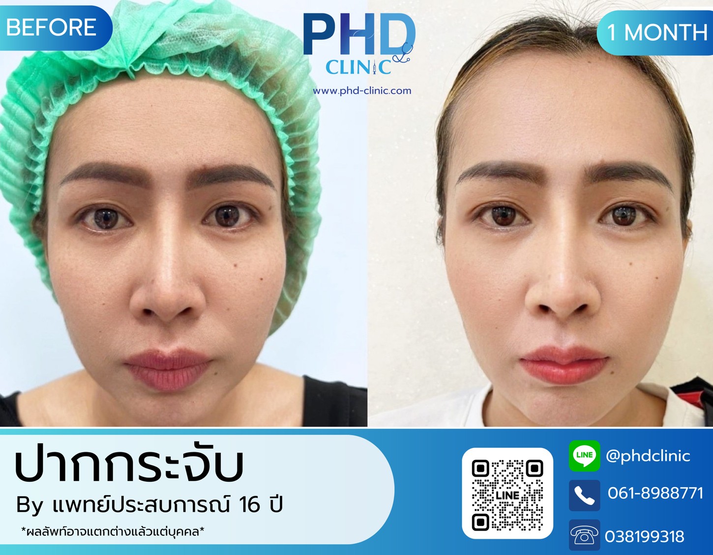 LINE_ALBUM_รีวิวปากกระจับ3