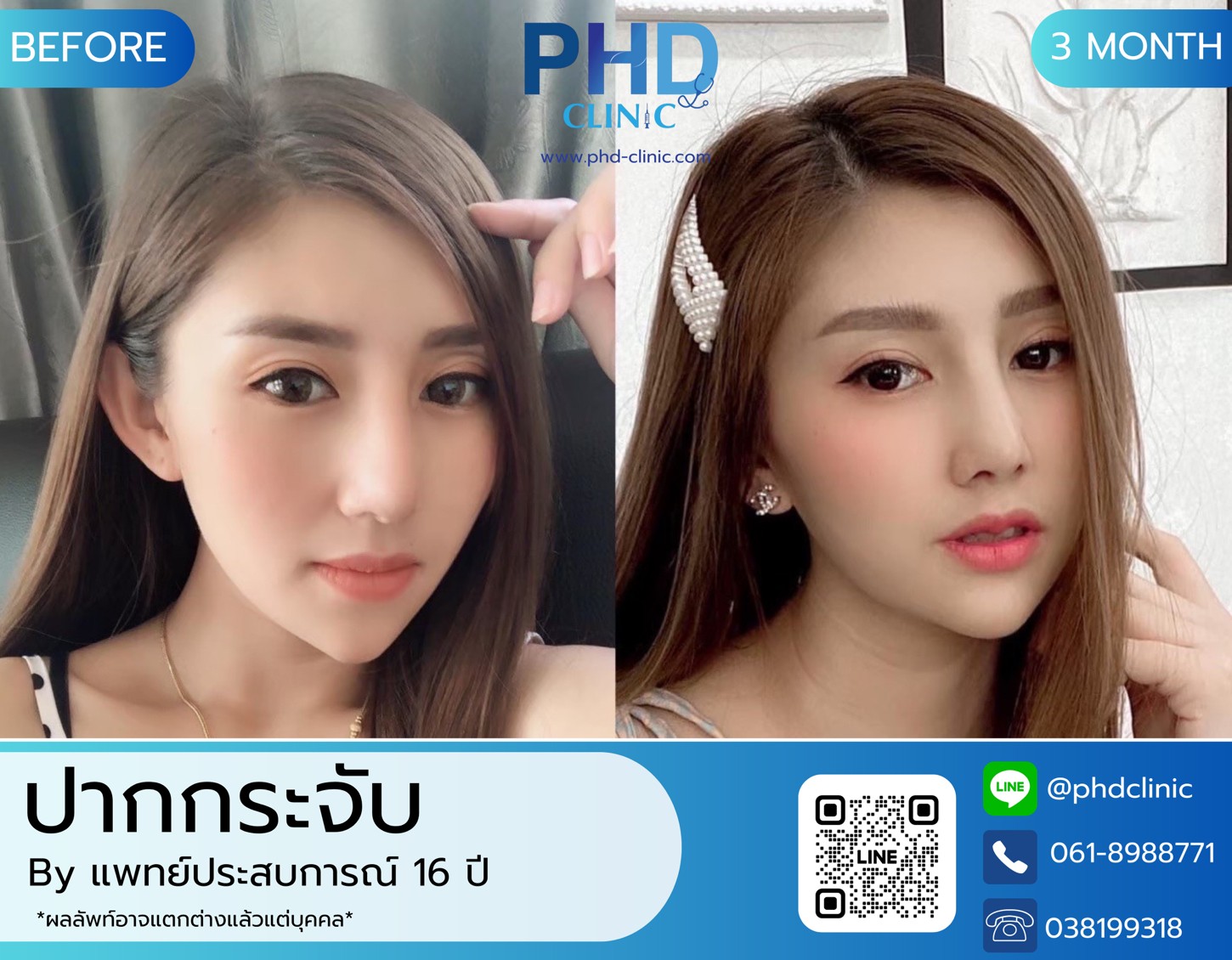 LINE_ALBUM_รีวิวปากกระจับ9