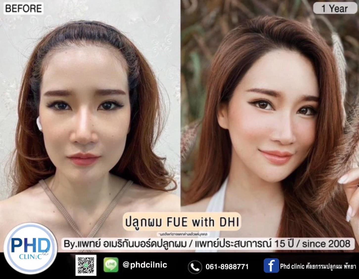 ปลูกผม_01