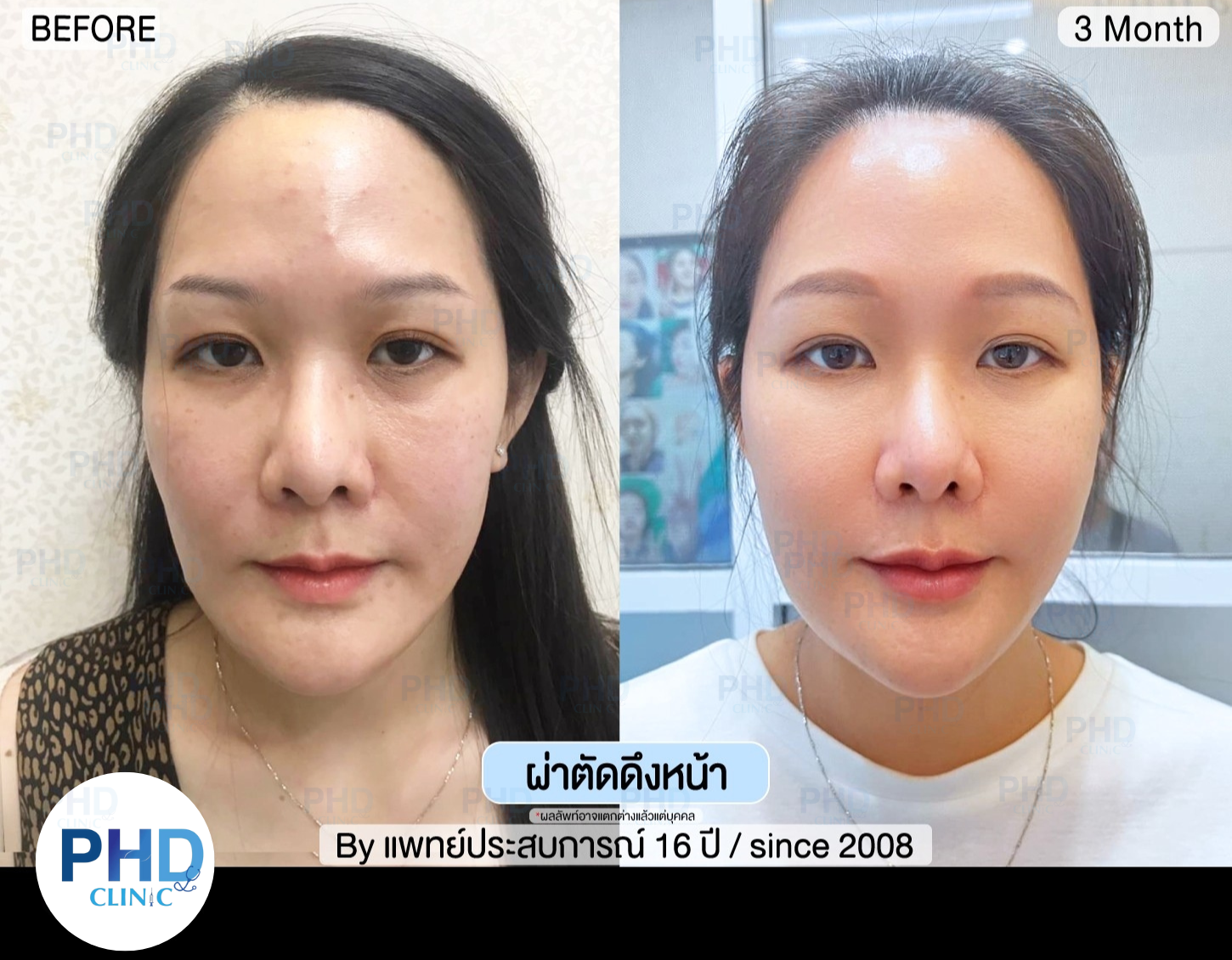ดึงหน้าภูเก็ต