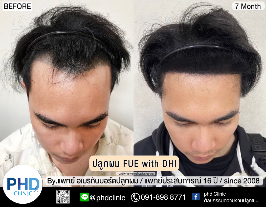 รีวิวปลูกผม3.10