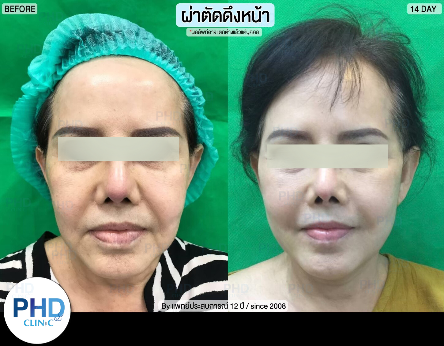 รีวิผ่าตัด ดึงหน้า 10