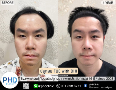 รีวิวปากกระจับ10.1