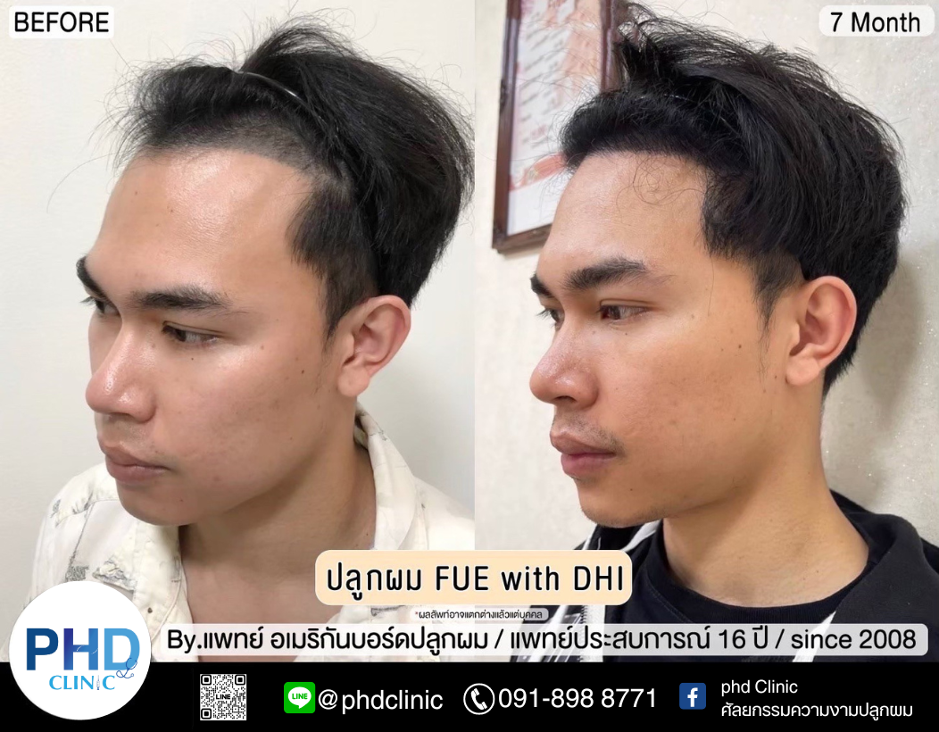 รีวิวปลูกผม3.11