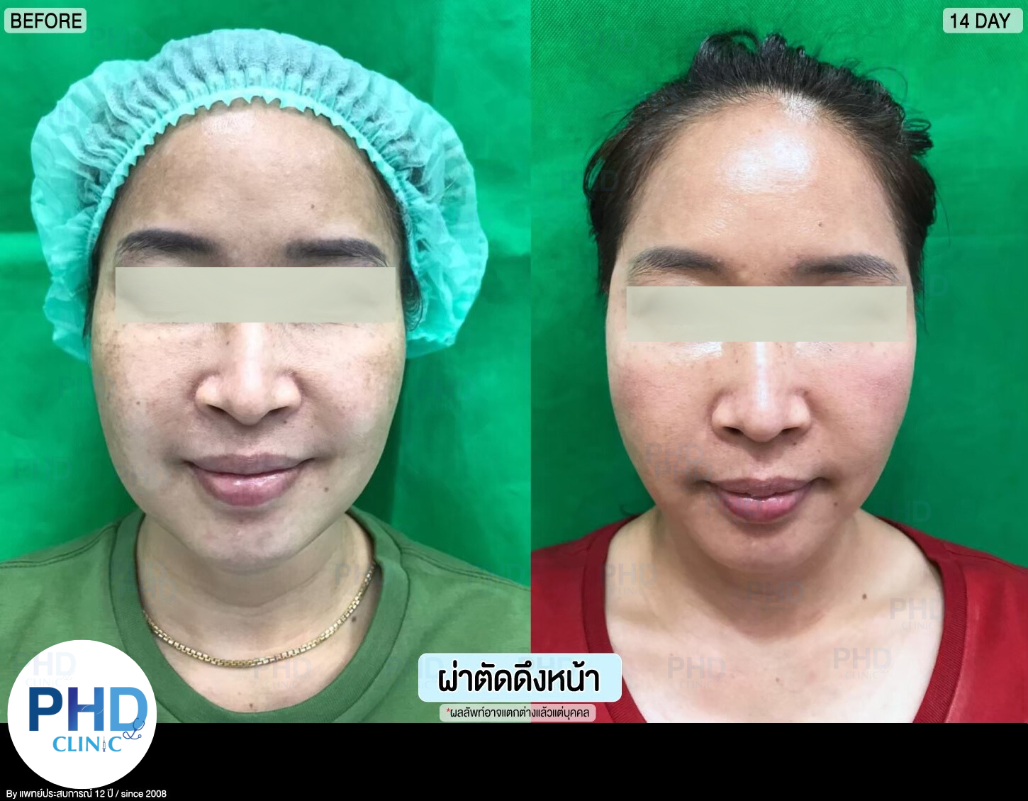 รีวิผ่าตัด ดึงหน้า 11