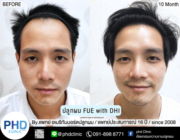 รีวิวปลูกผม5.12