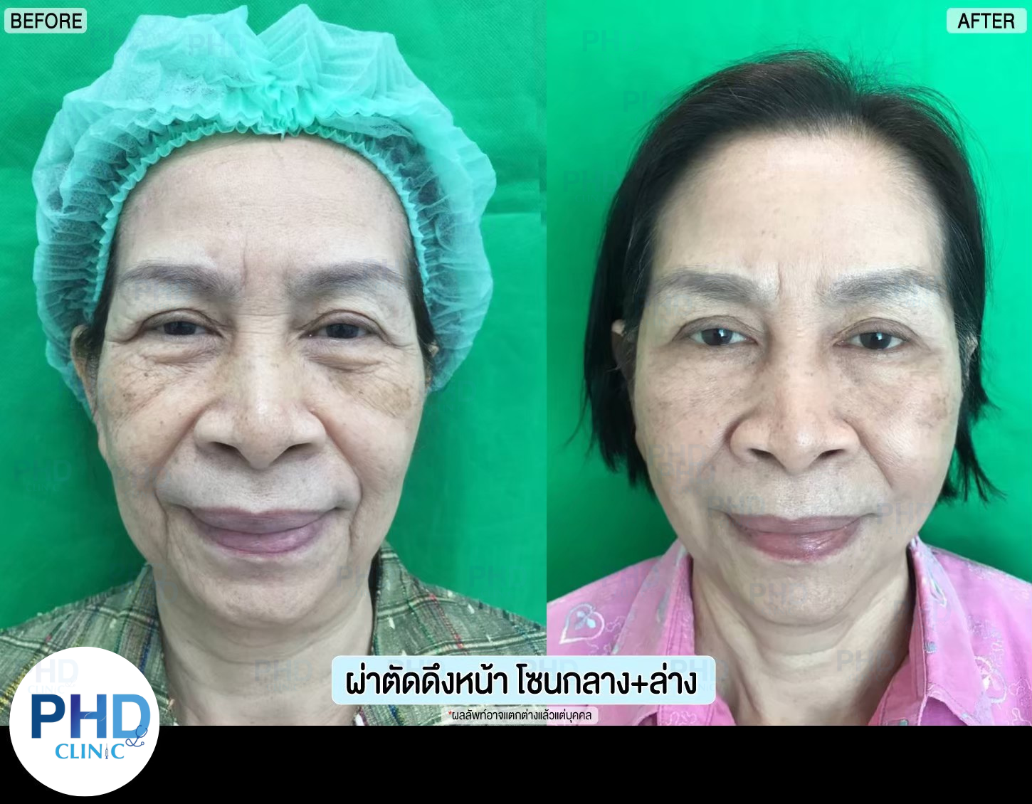 รีวิผ่าตัด ดึงหน้า 12