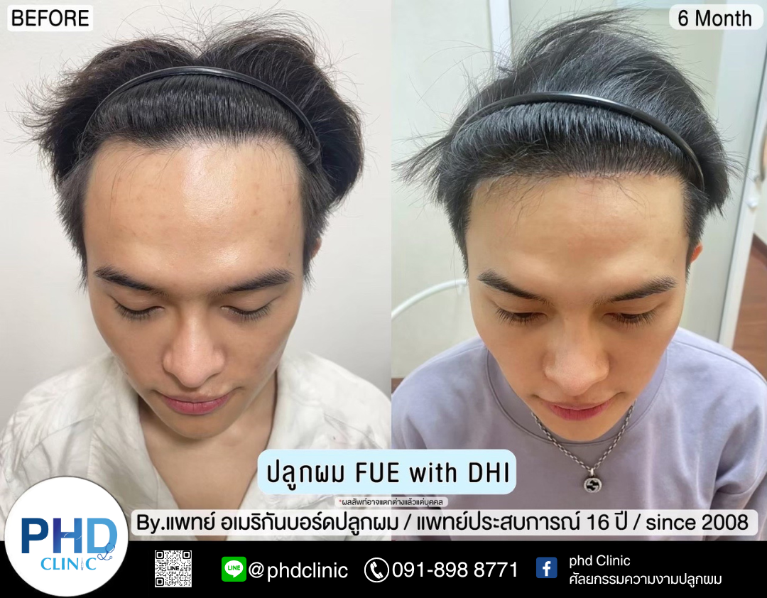 รีวิวปลูกผม4.13