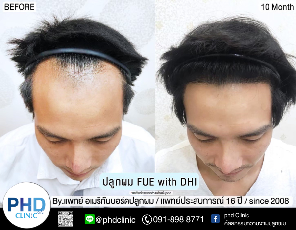 รีวิวปลูกผม5.13