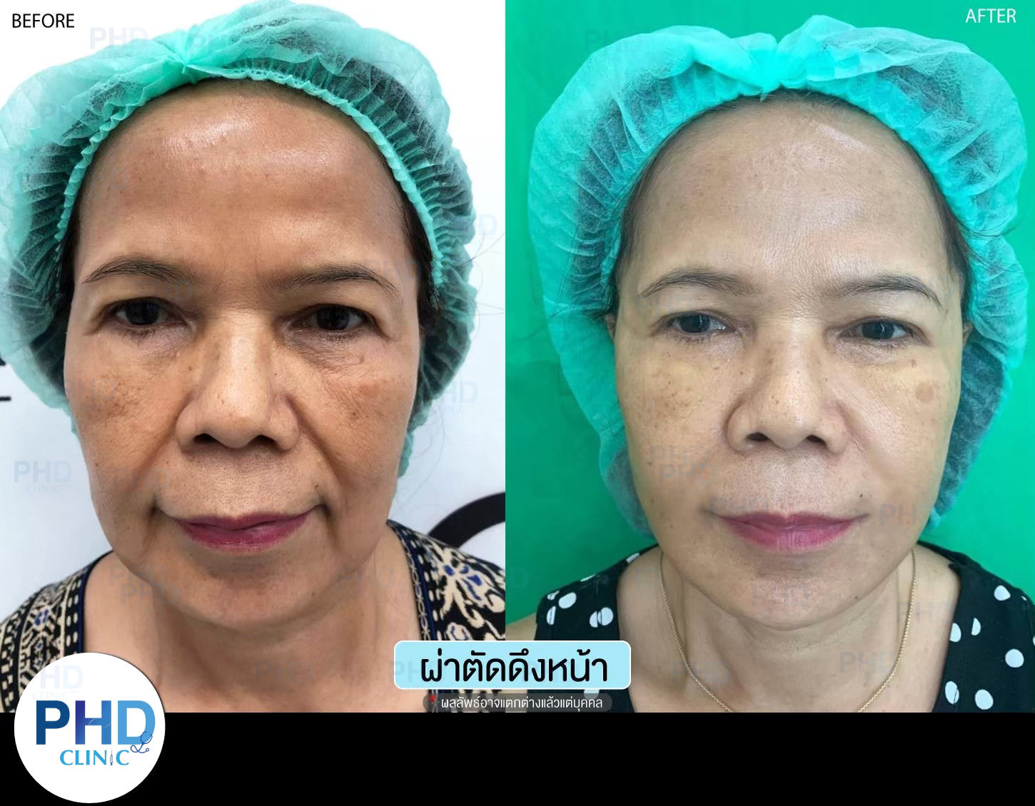 ดึงหน้าภูเก็ต