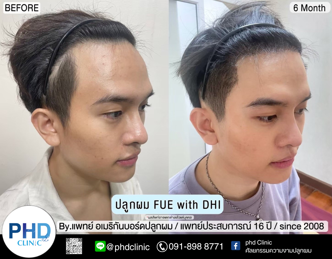 รีวิวปลูกผม4.14