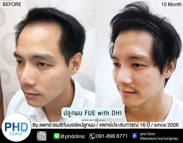 รีวิวปลูกผม5.14