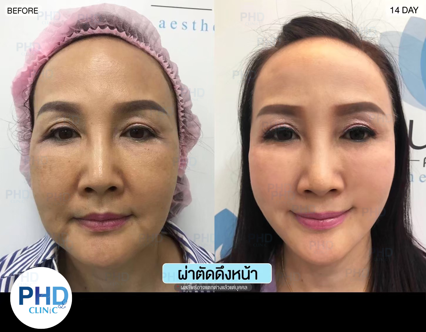 ดึงหน้าภูเก็ต