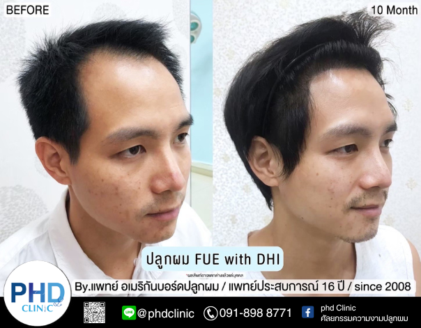 รีวิวปลูกผม5.15