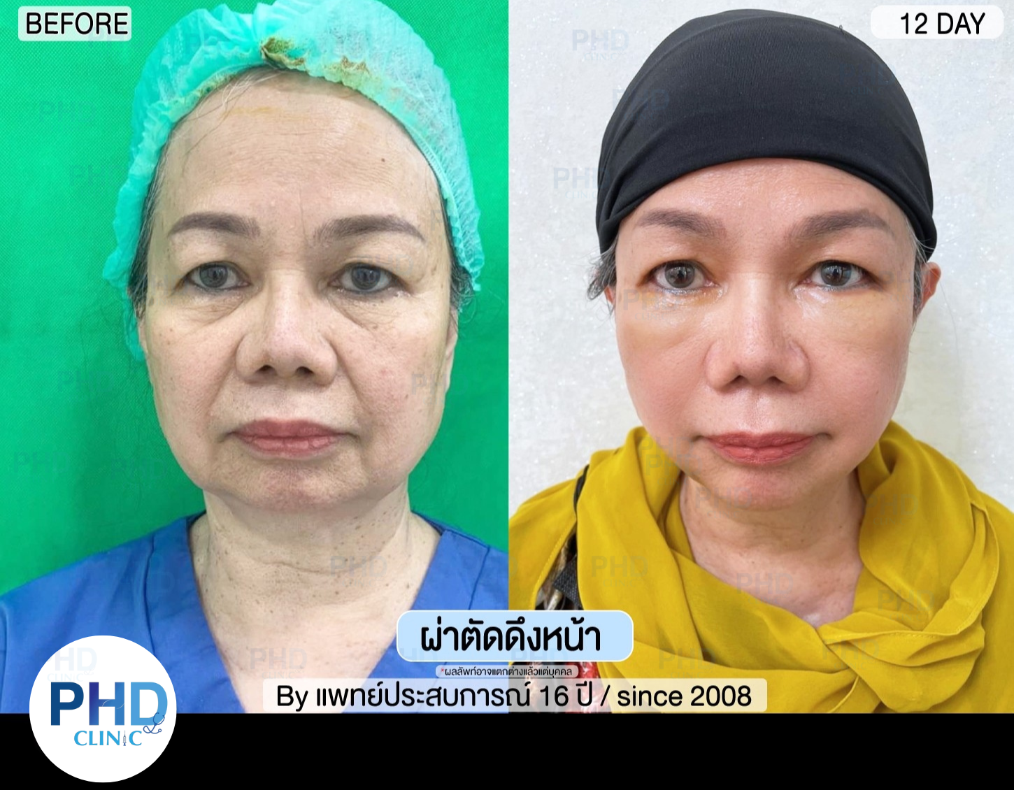 รีวิผ่าตัด ดึงหน้า 2