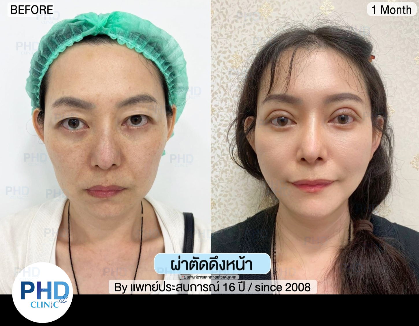 ดึงหน้าภูเก็ต