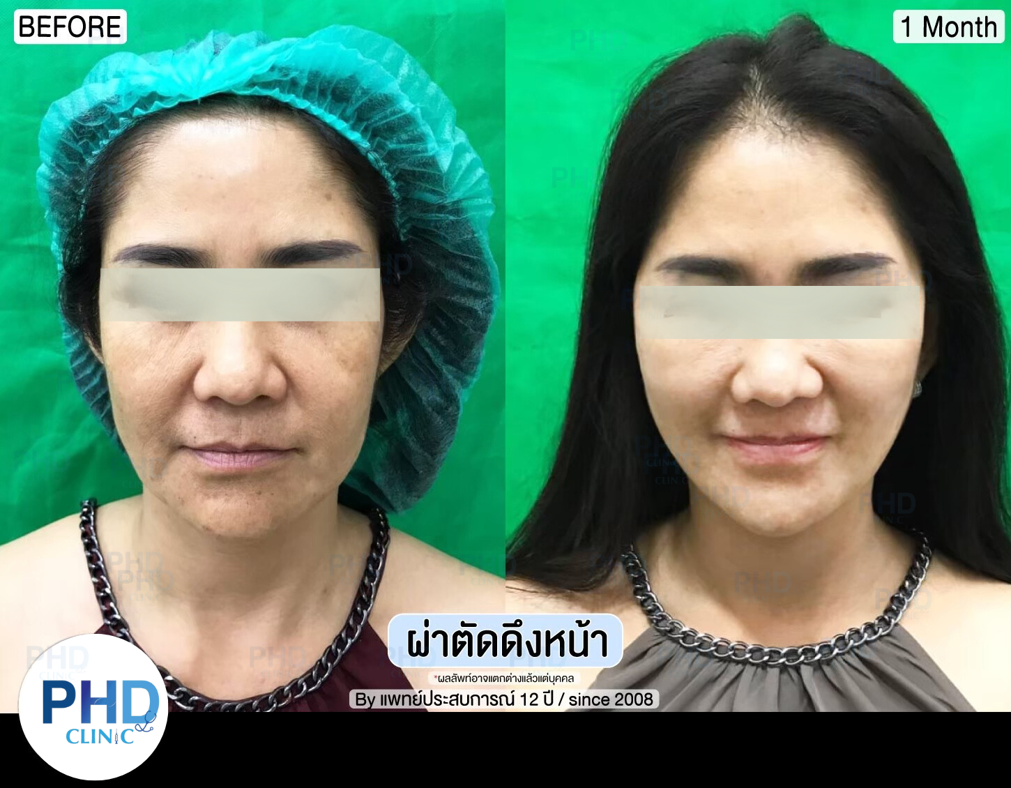 รีวิผ่าตัด ดึงหน้า 4