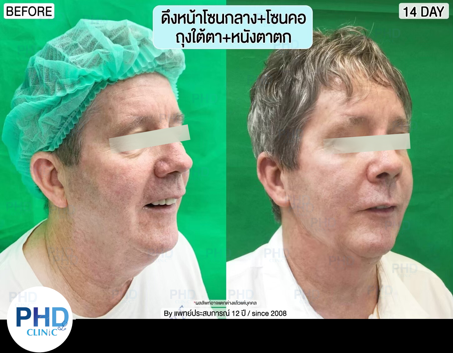 รีวิผ่าตัด ดึงหน้า 5
