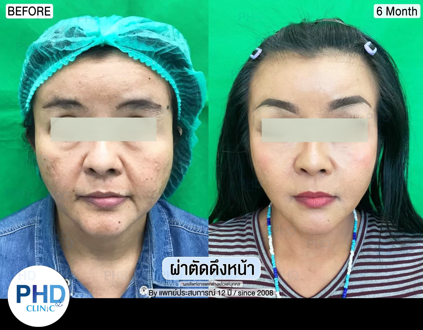 รีวิผ่าตัด ดึงหน้า 6