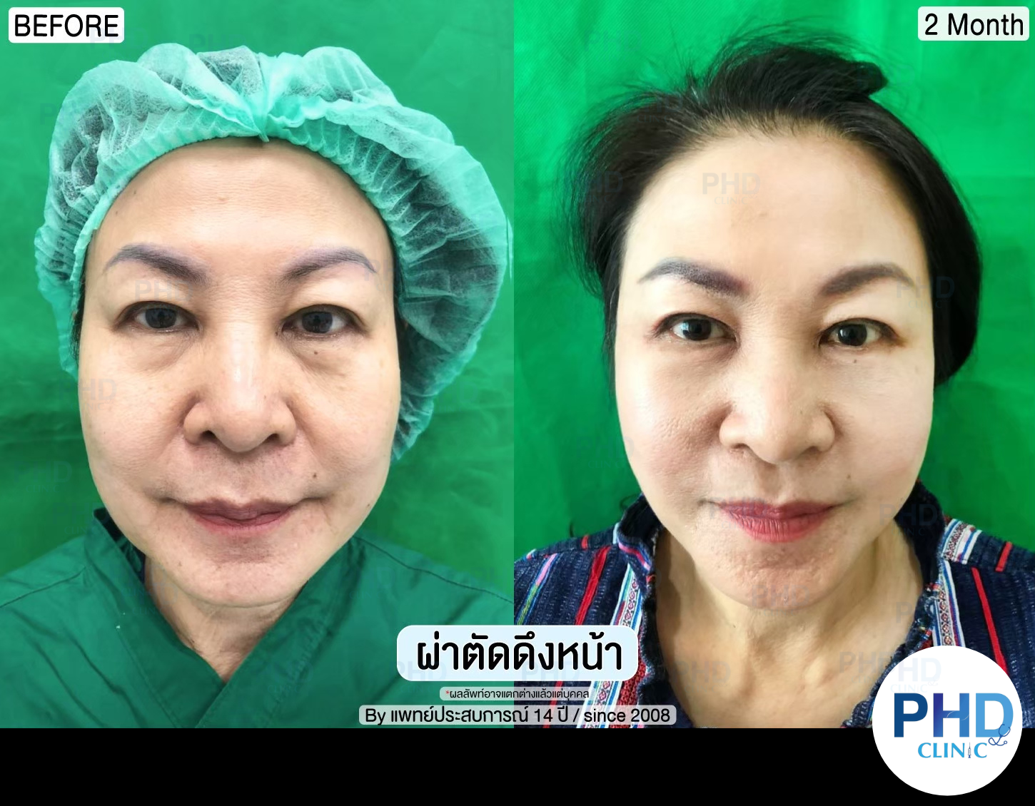 รีวิผ่าตัด ดึงหน้า 7