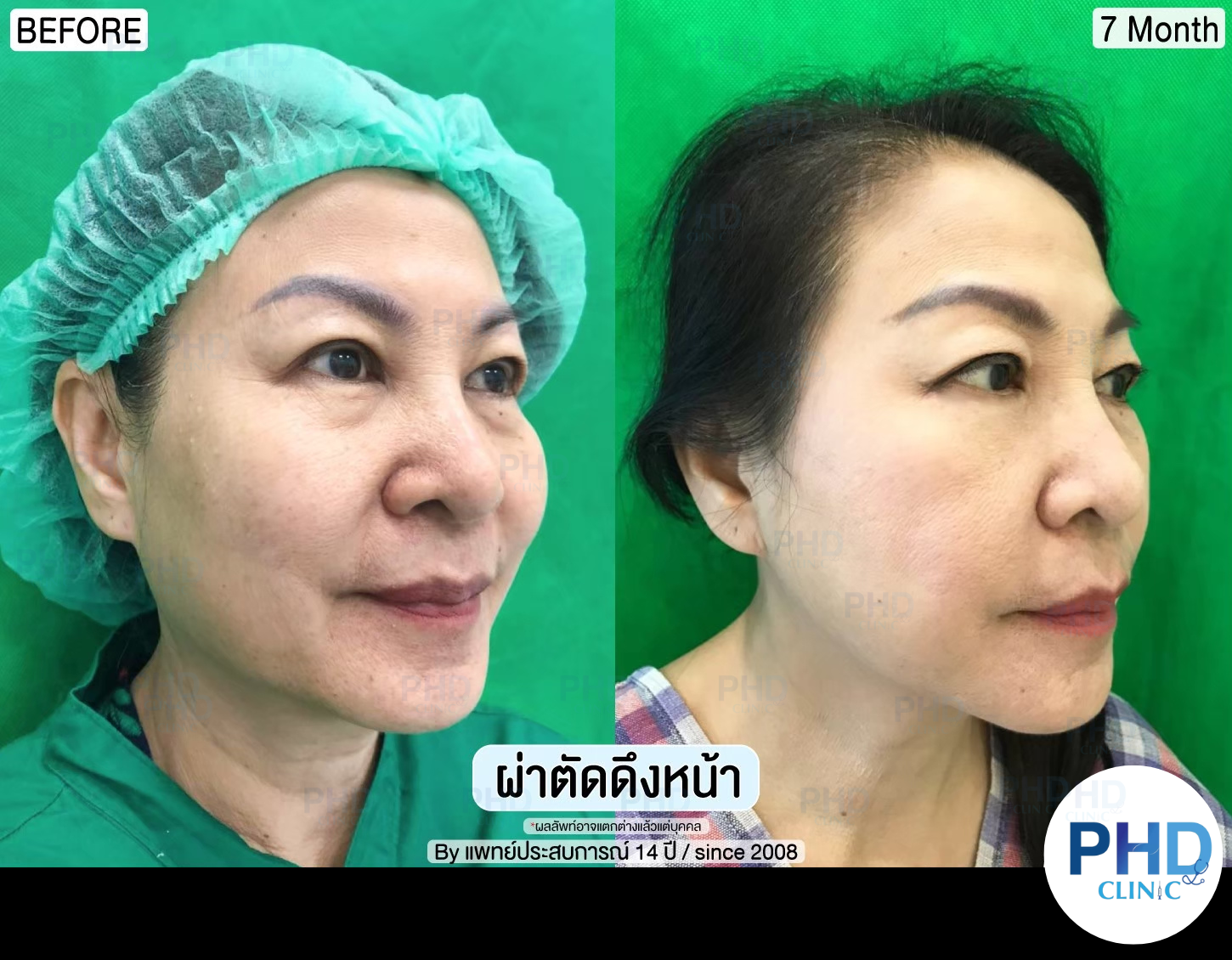 รีวิผ่าตัด ดึงหน้า 8