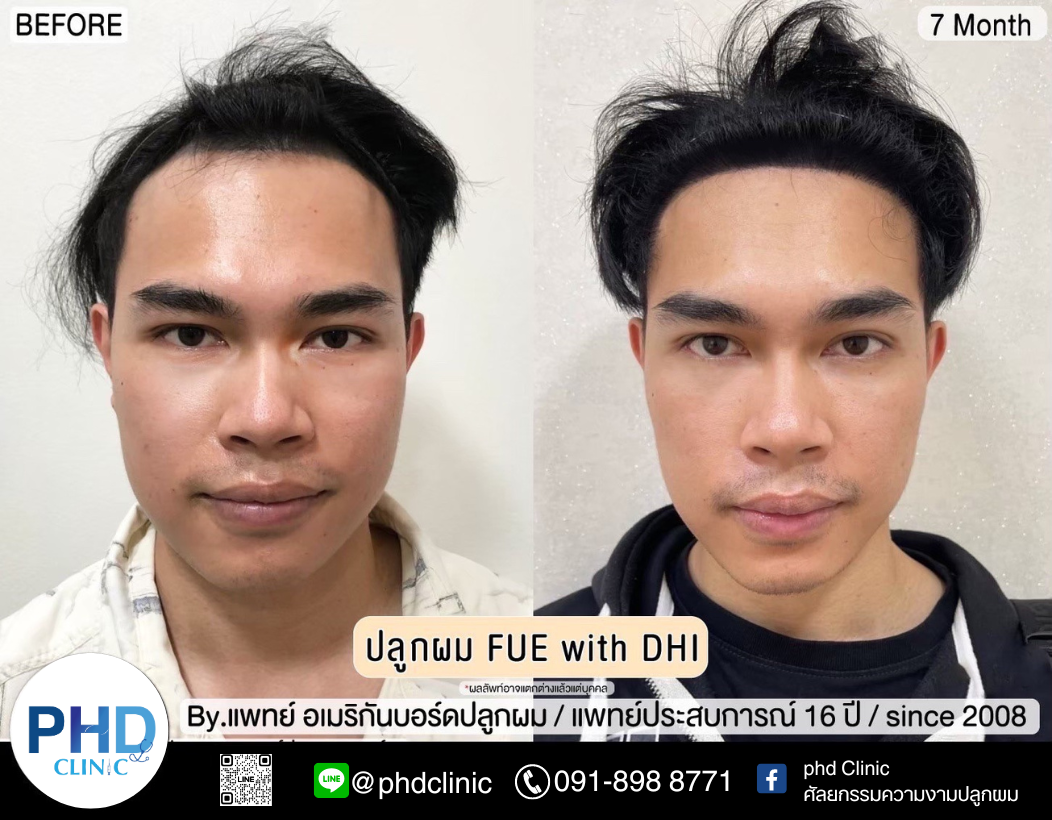 รีวิวปลูกผม3.9