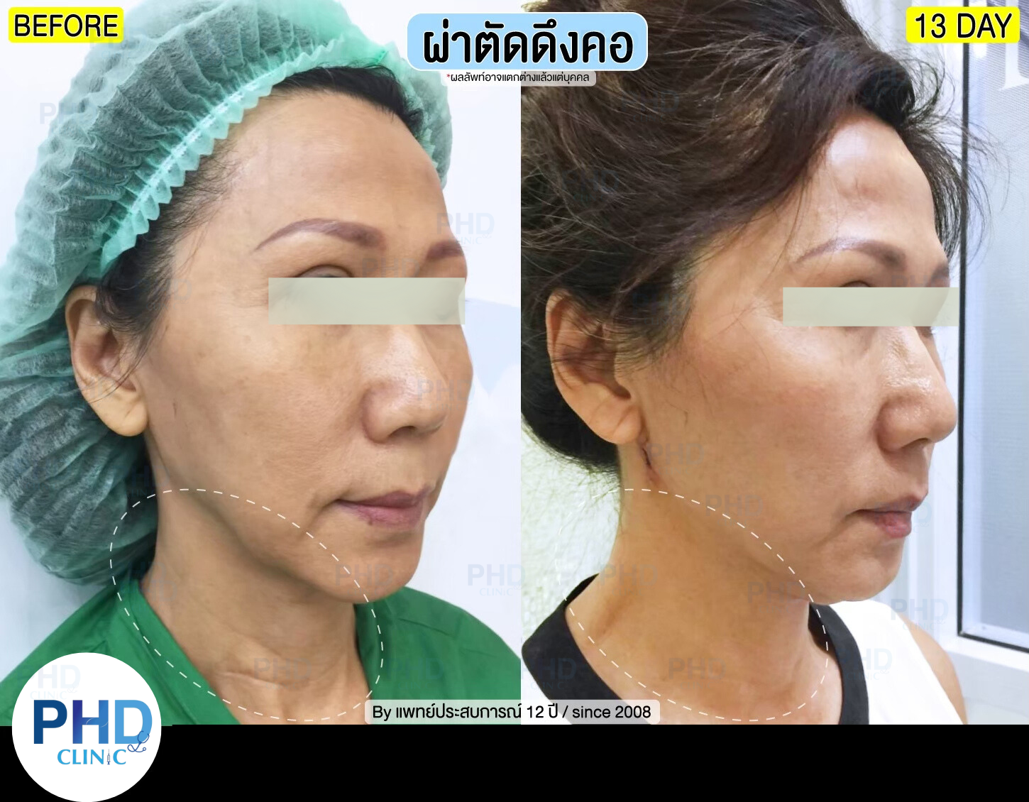 ดึงหน้าภูเก็ต
