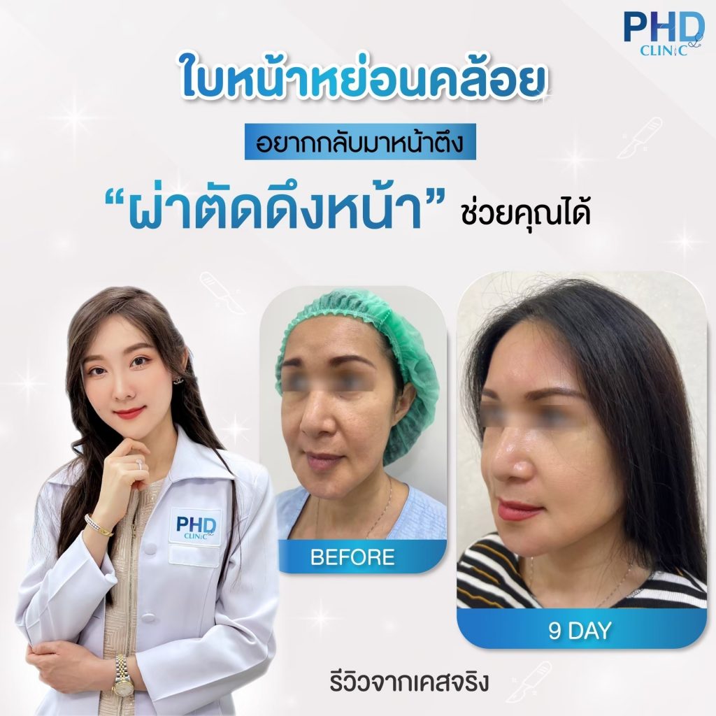 ดึงหน้าภูเก็ต