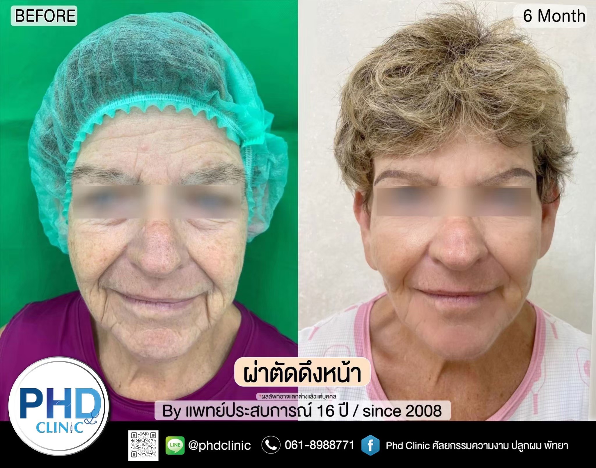 ดึงหน้าภูเก็ต