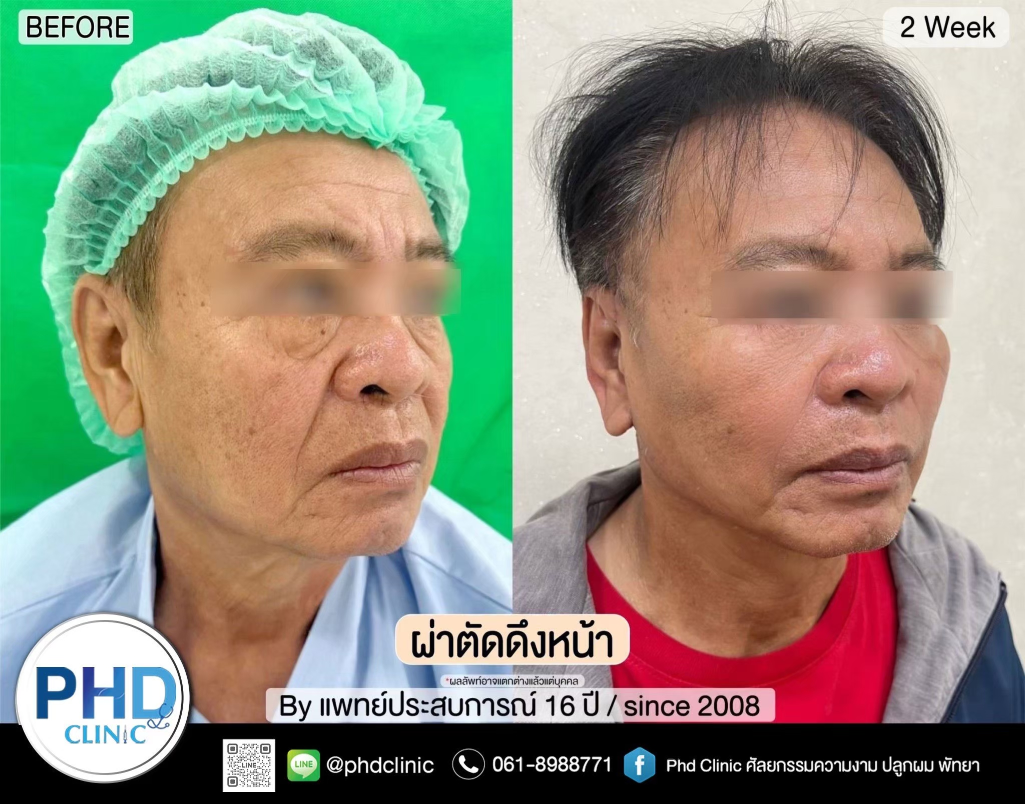 ผ่าตัดดึงหน้า