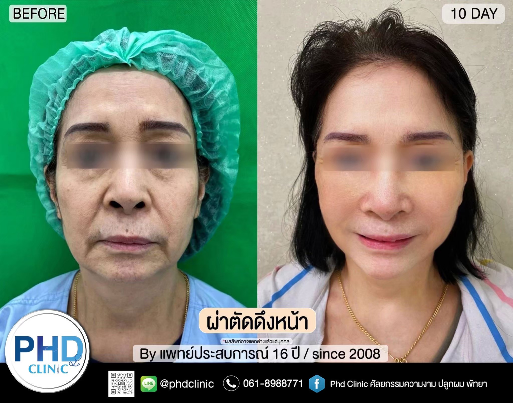 ดึงหน้าภูเก็ต
