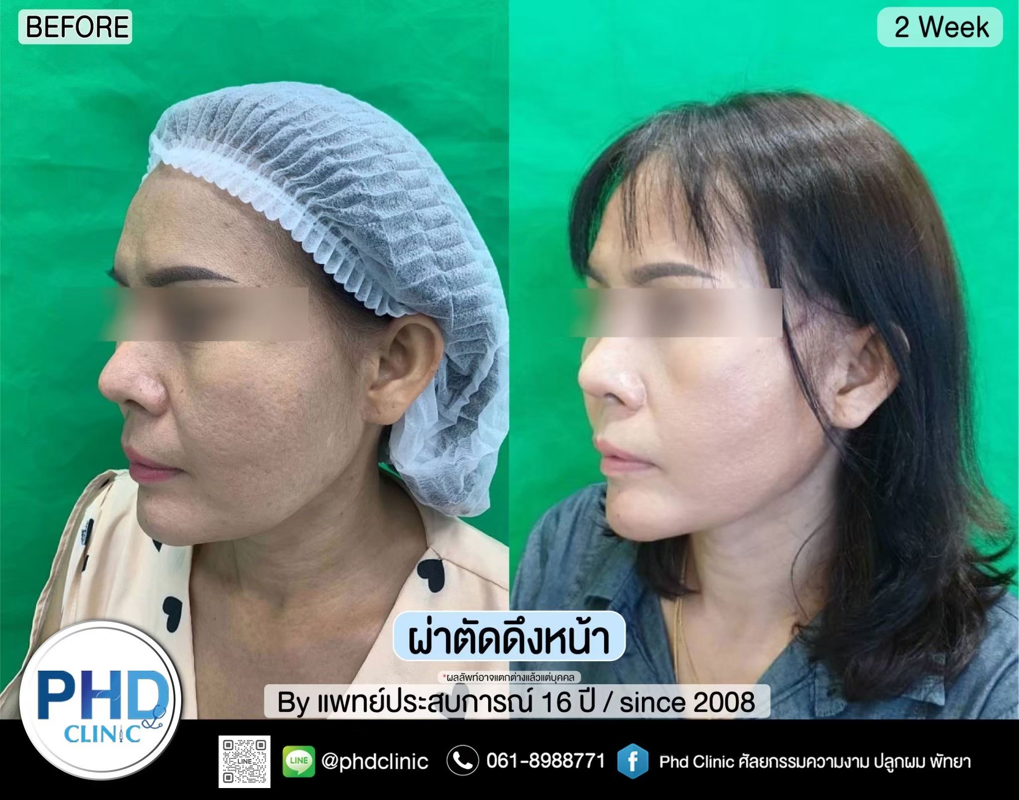 ผ่าตัดดึงหน้า