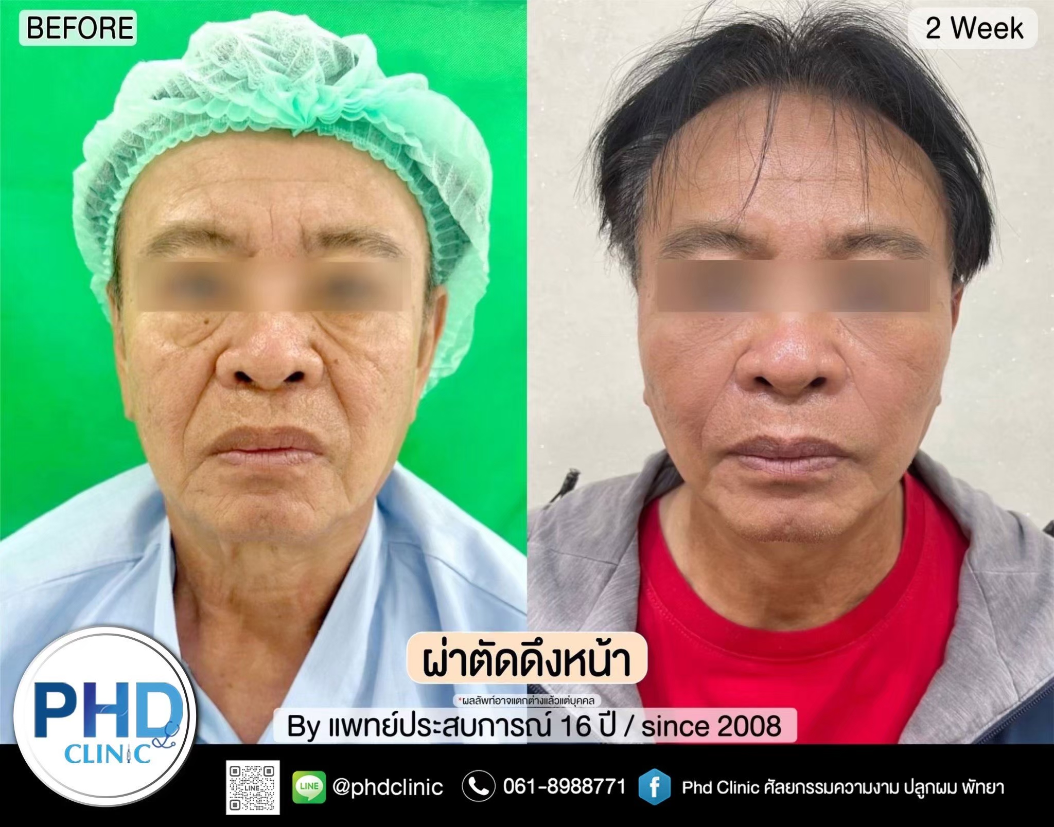 ผ่าตัดดึงหน้า