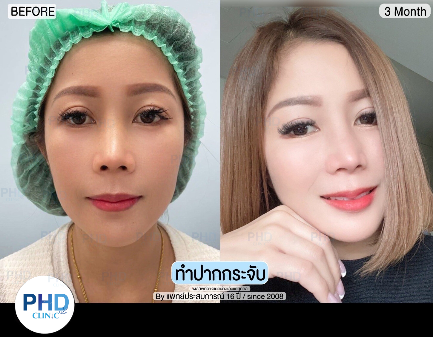รีวิวปากกระจับ10.2