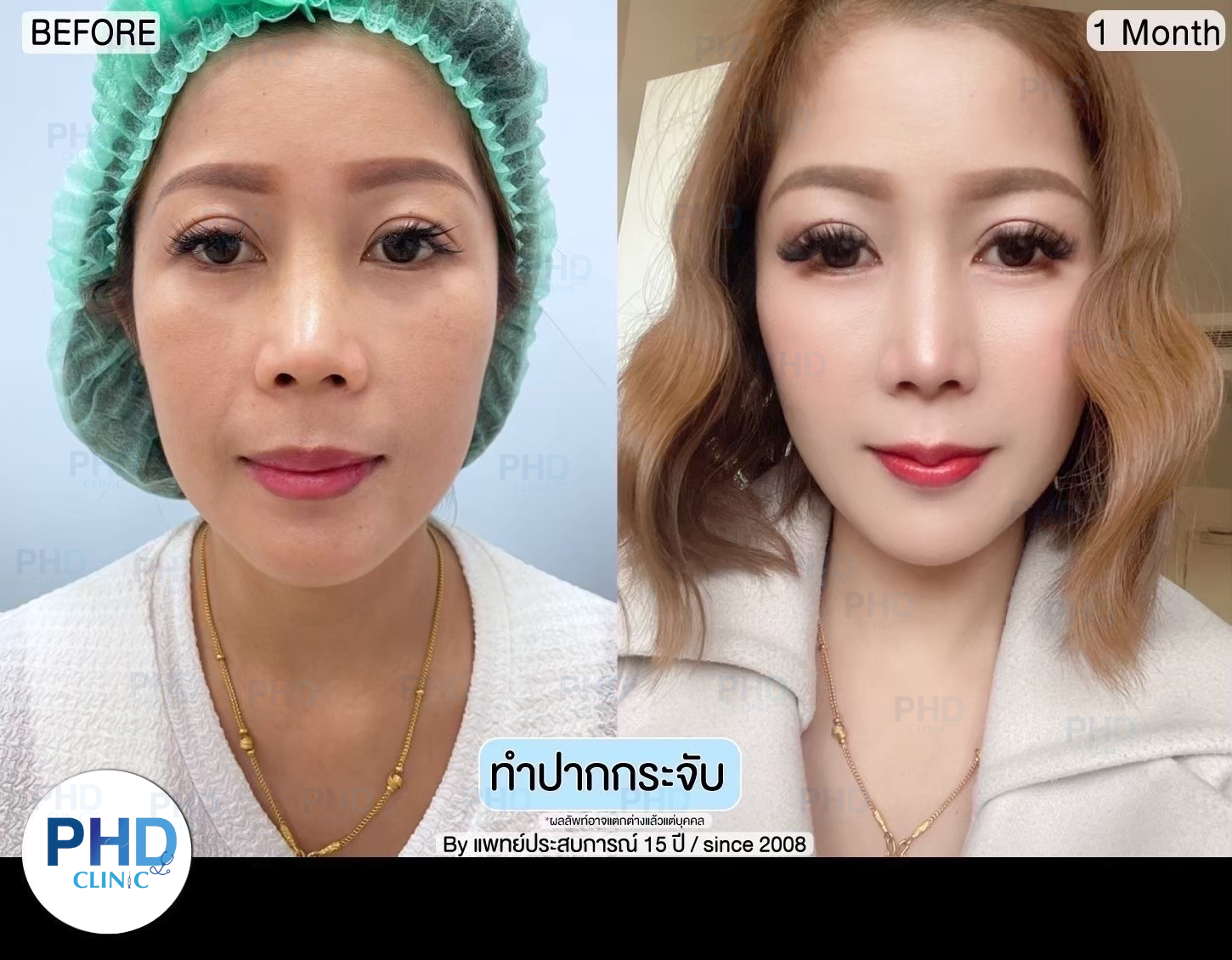 รีวิวปากกระจับ10.1